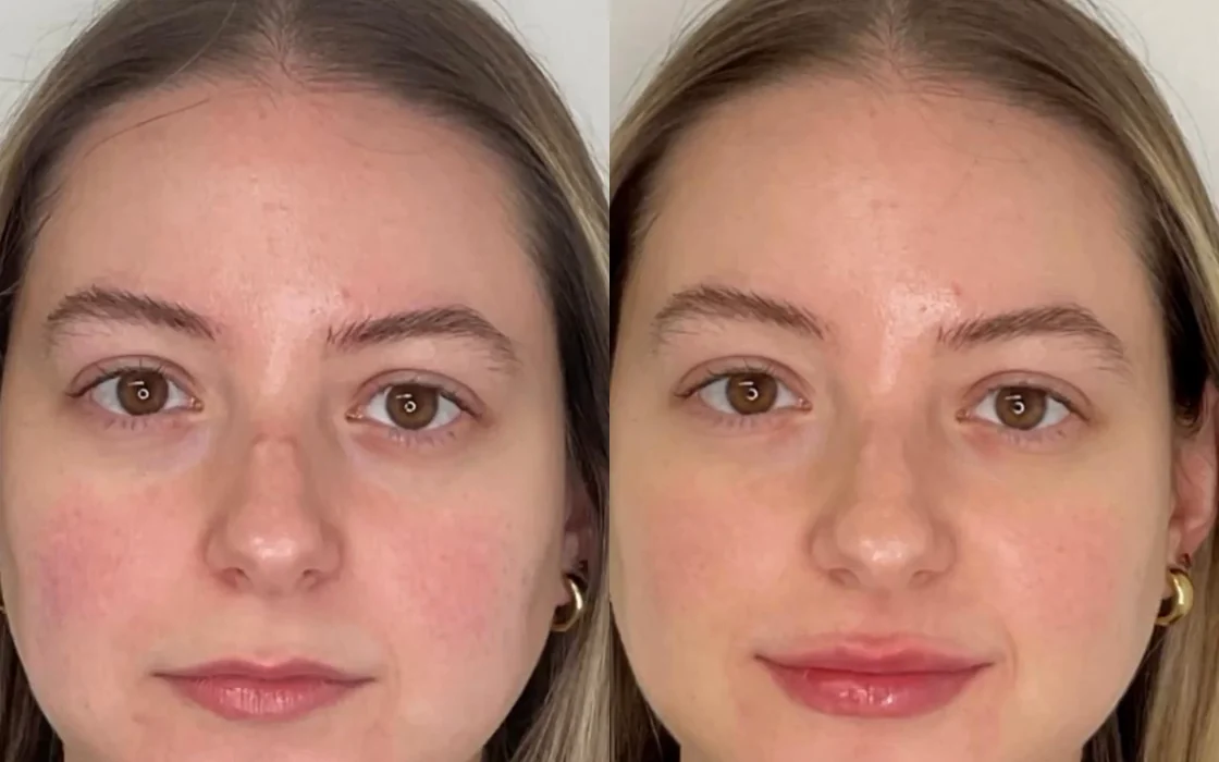 Before Lip & chin filler, front view, Femme Aesthetics patient