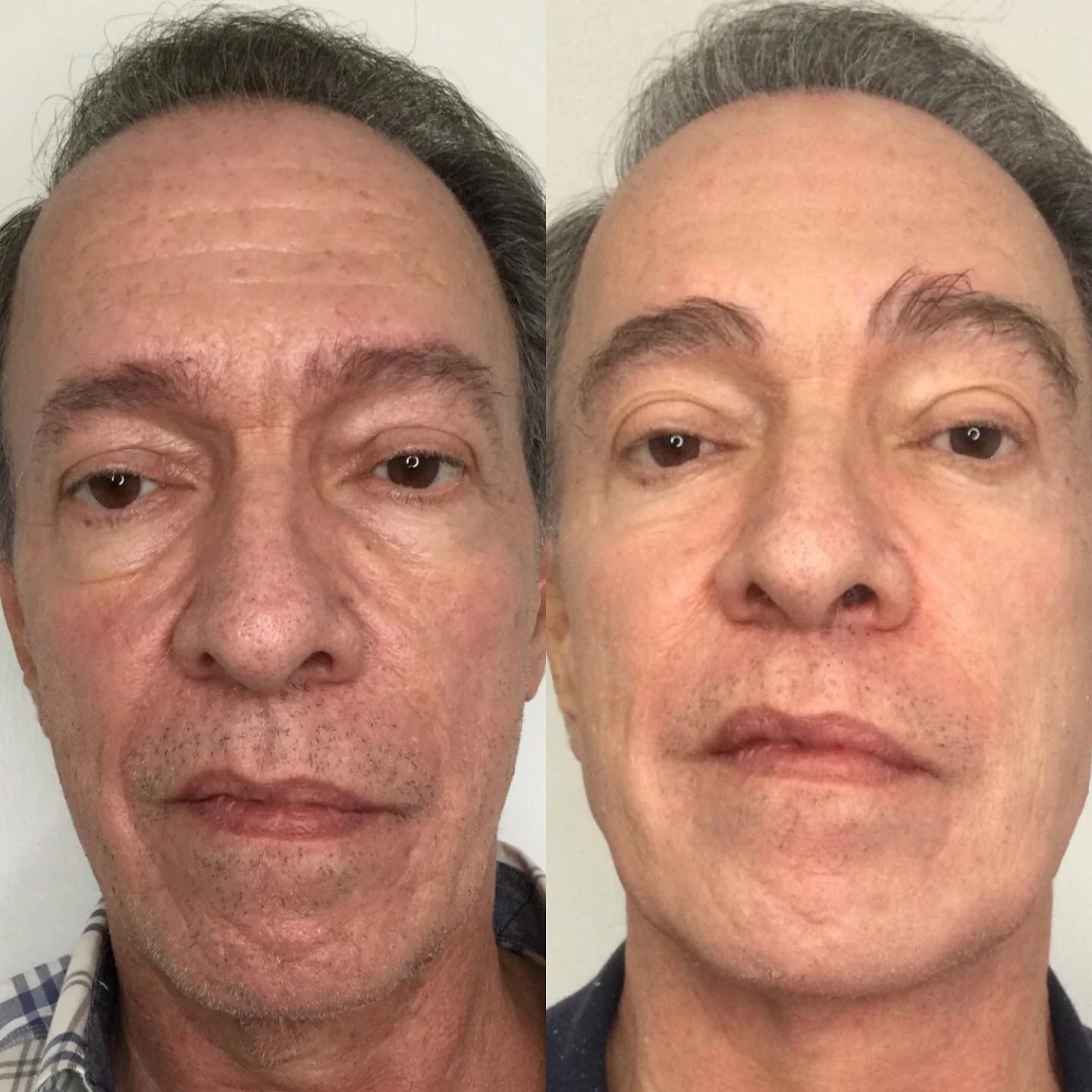 Before and after Morpheus8 at Femme Aesthetics, front view