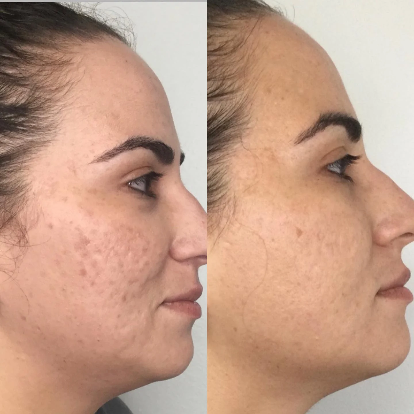 Before and after Morpheus8 at Femme Aesthetics, profile view