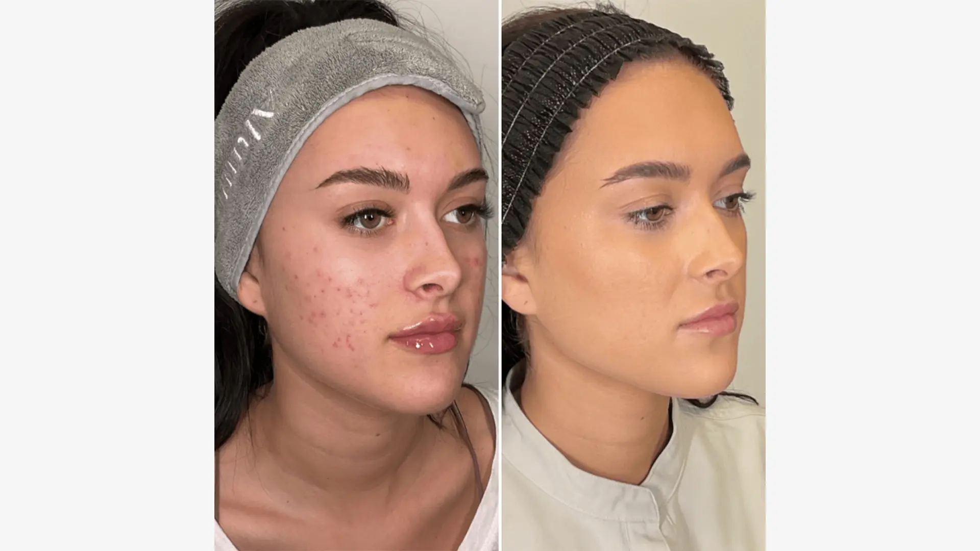 Acne Scar Treatment Before and After Result 1