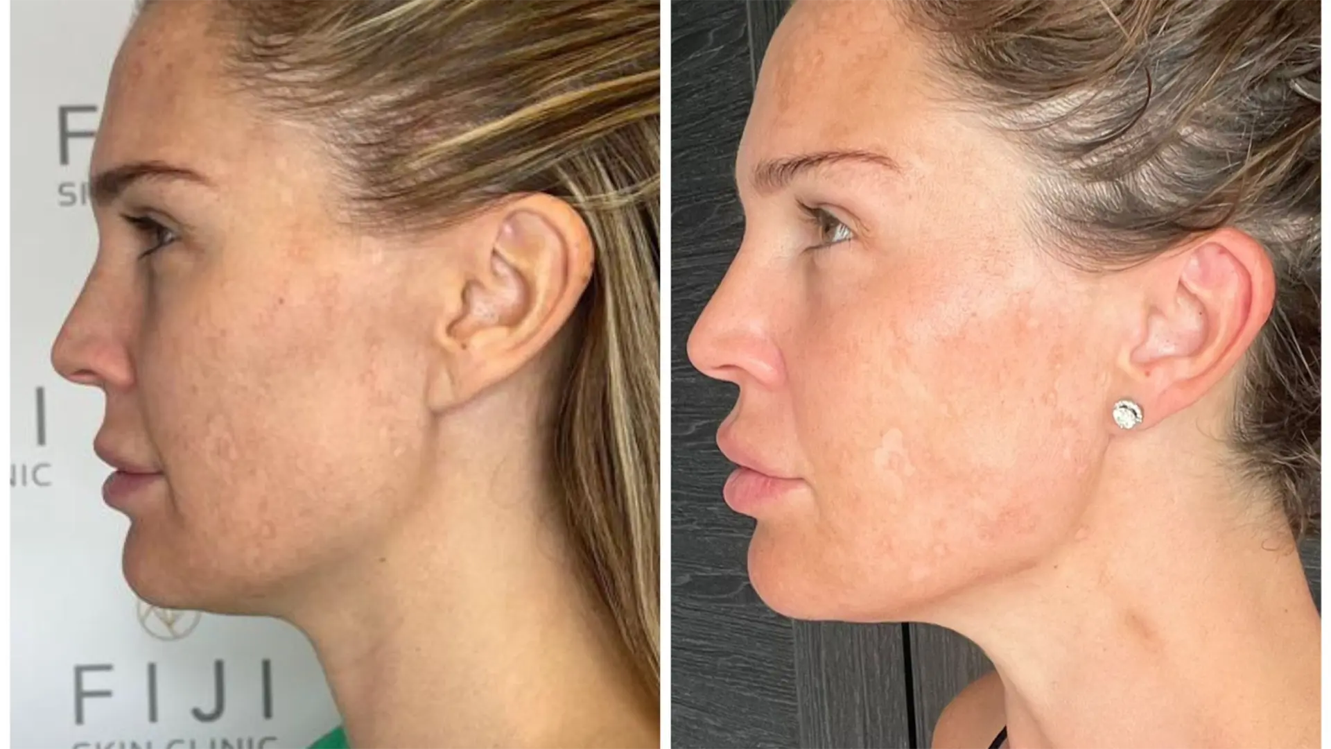 Acne Scar Treatment Before and After Result 2