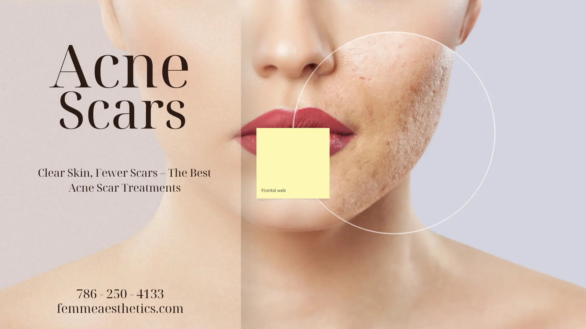 Acne Scar Treatments Best Options to Get Rid of Scars