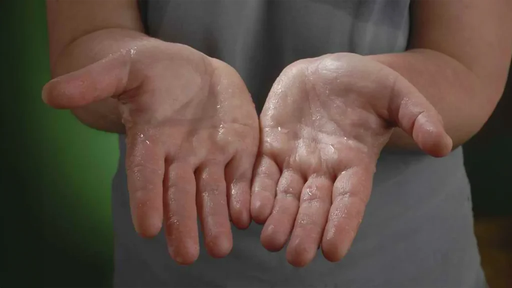 Mujer recibiendo tratamiento de Botox para manos sudorosas