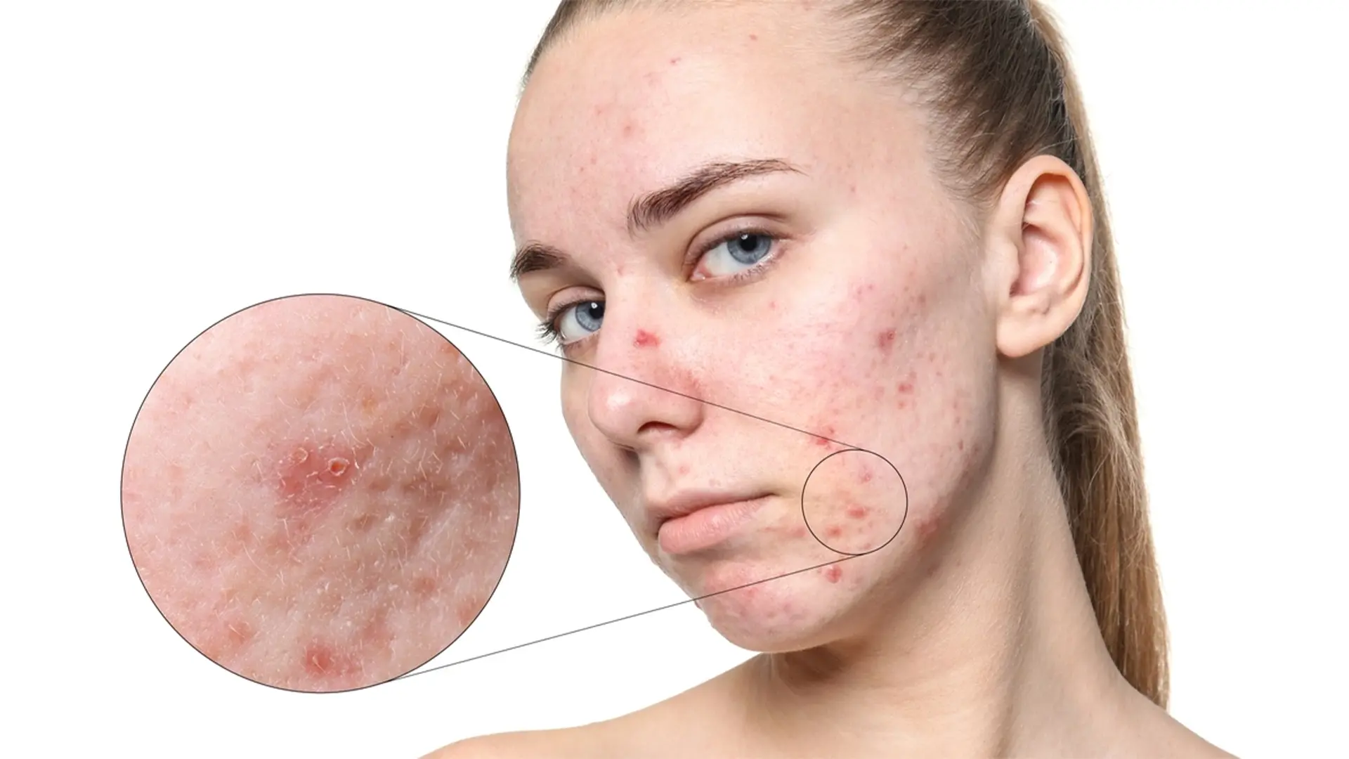 Common Types of Acne Scars