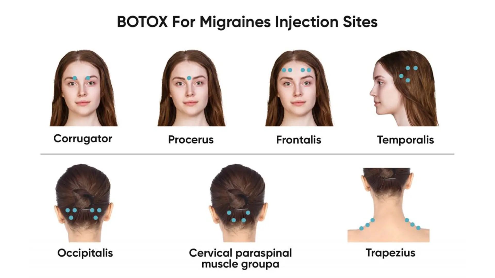 Creating a Personalized Botox Treatment Plan injection Sites