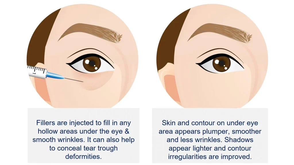 Rellenos dérmicos para ojeras - El procedimiento