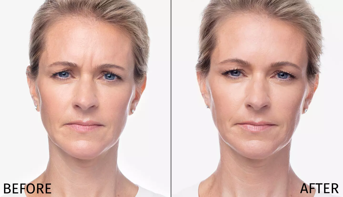 Dysport Before and After Results - Deven