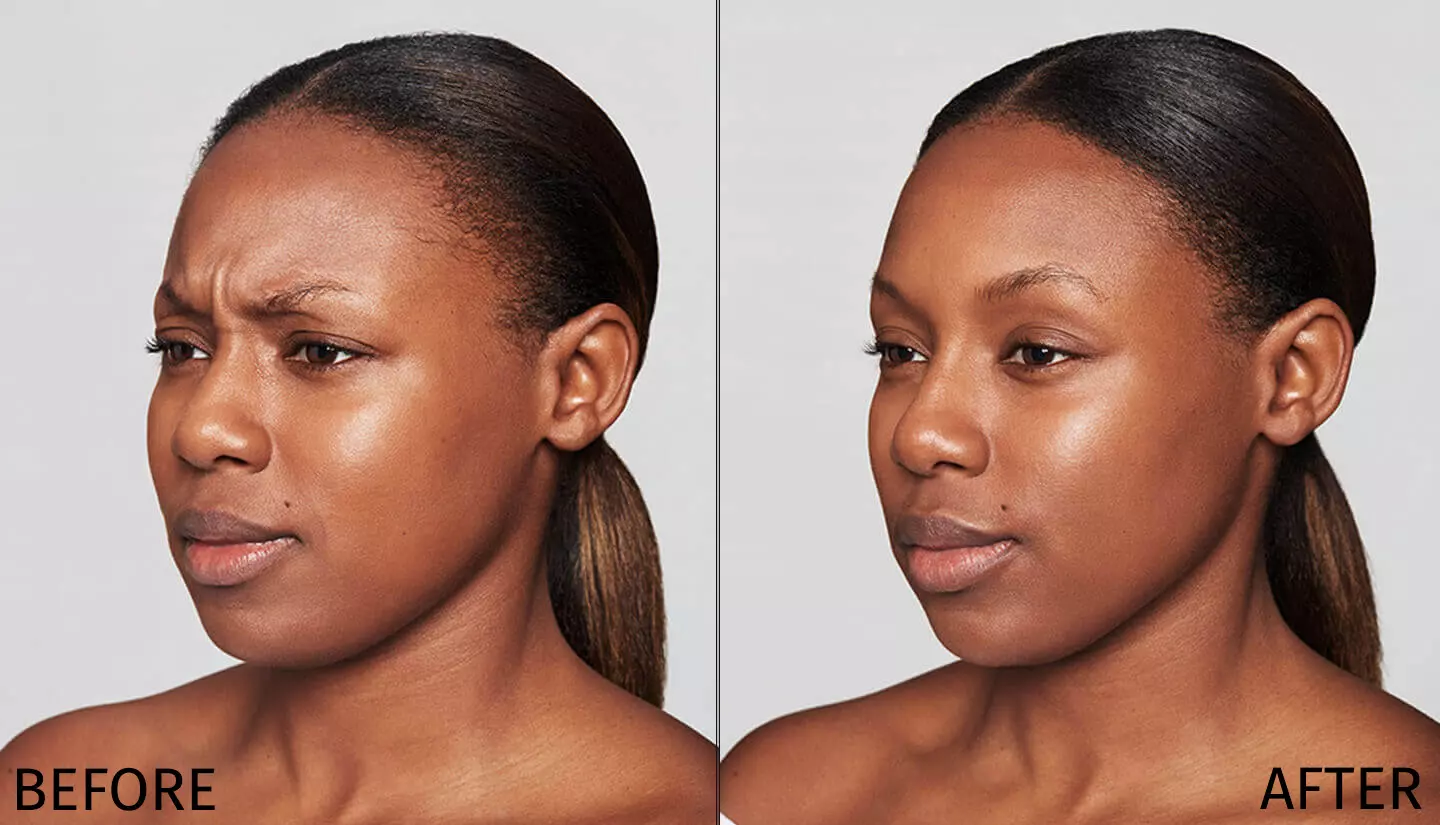 Dysport Before and After Results - Salimah
