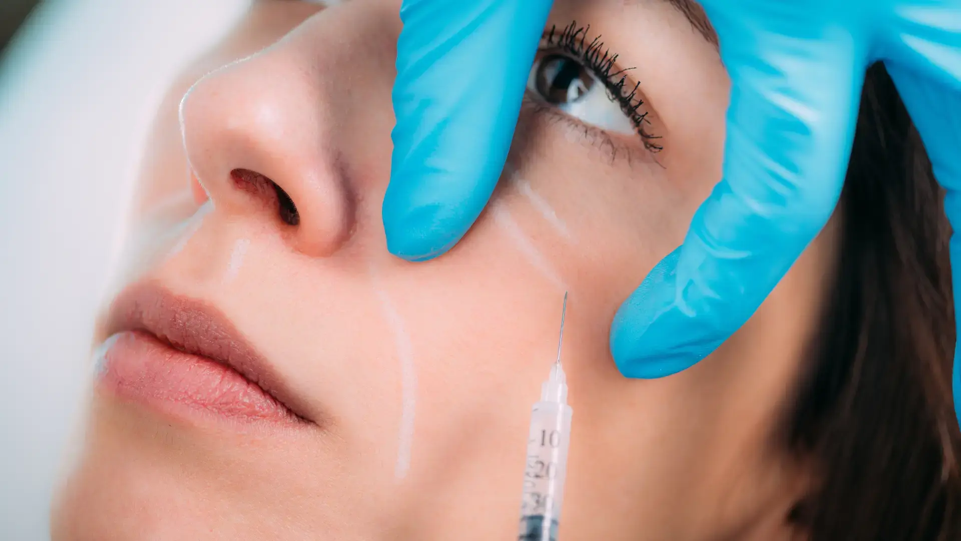 Sculptra biostimulator injection for post-GLP-1 facial volume loss
