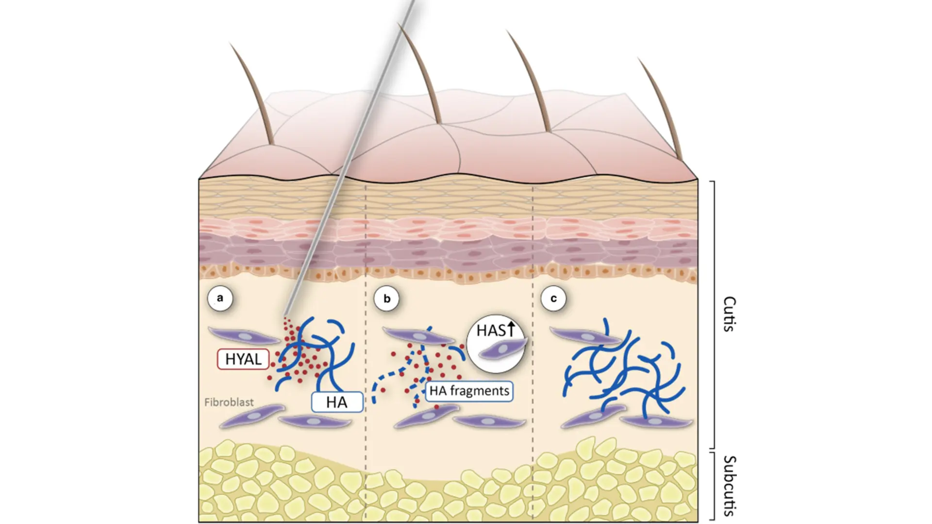 HA digestion with hyaluronidase femme aesthetics miami
