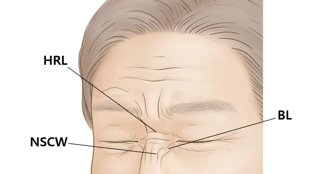 Holistic Approach to Facial Rejuvenation including Bunny Lines