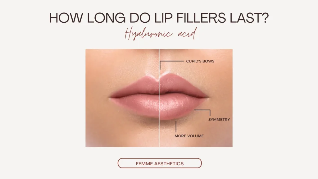 How Long Do Lip Fillers Last