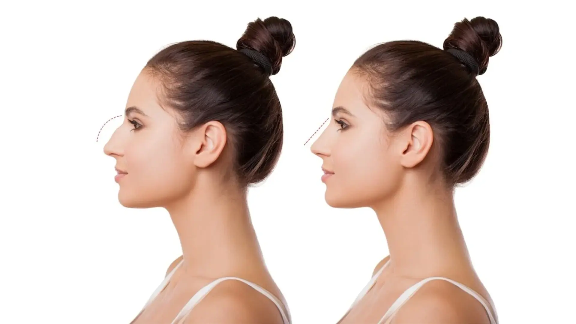 Liquid Rhinoplasty Before and After