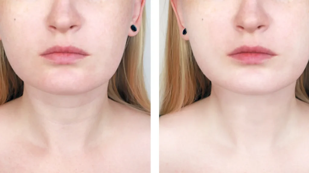 Nefertiti Neck Lift before and after results showing improved jawline definition