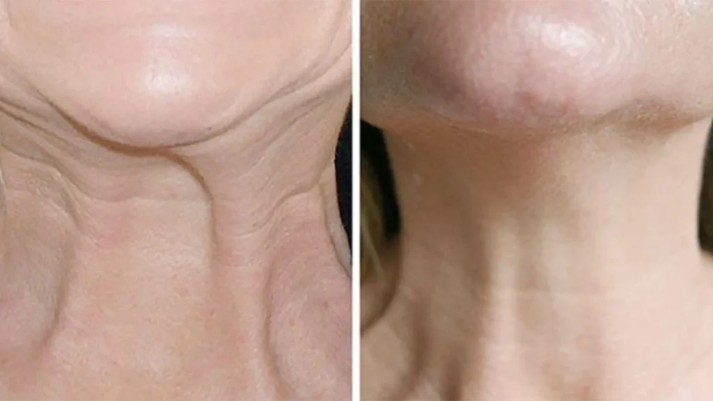 Nefertiti Neck Lift before and after results showing contoured neck profile