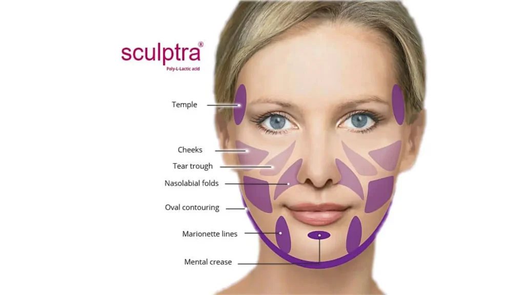 Áreas de tratamiento facial con Sculptra
