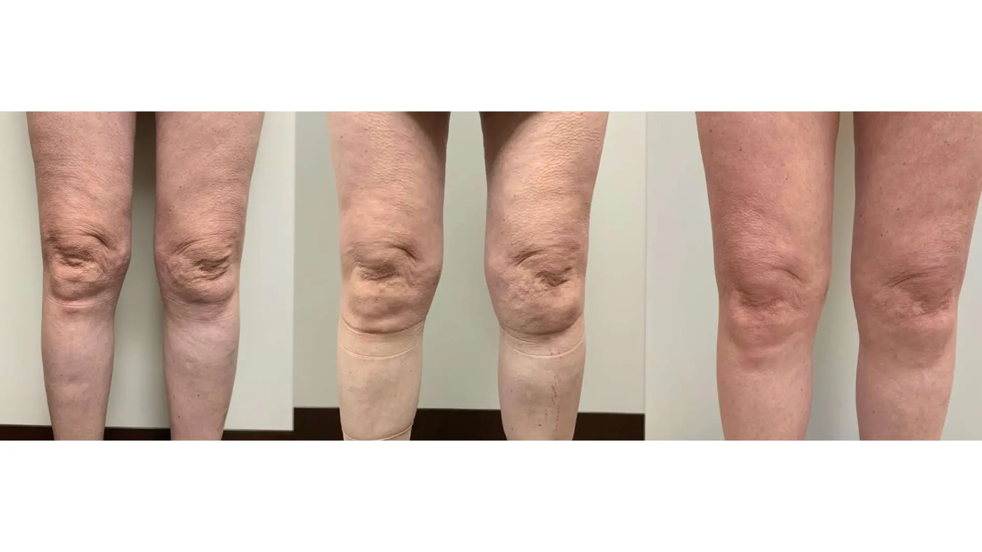 Stretch Mark Removal Near Me Before and After Miami