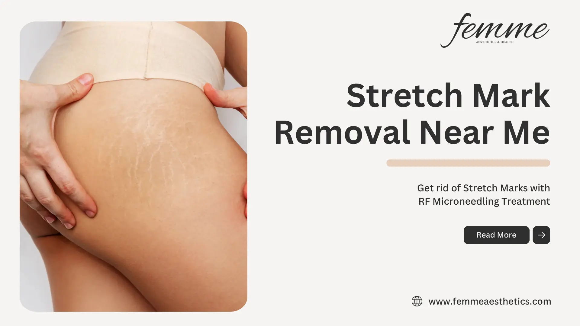 Stretch Mark Removal Near Me at Femme Aesthetics Miami