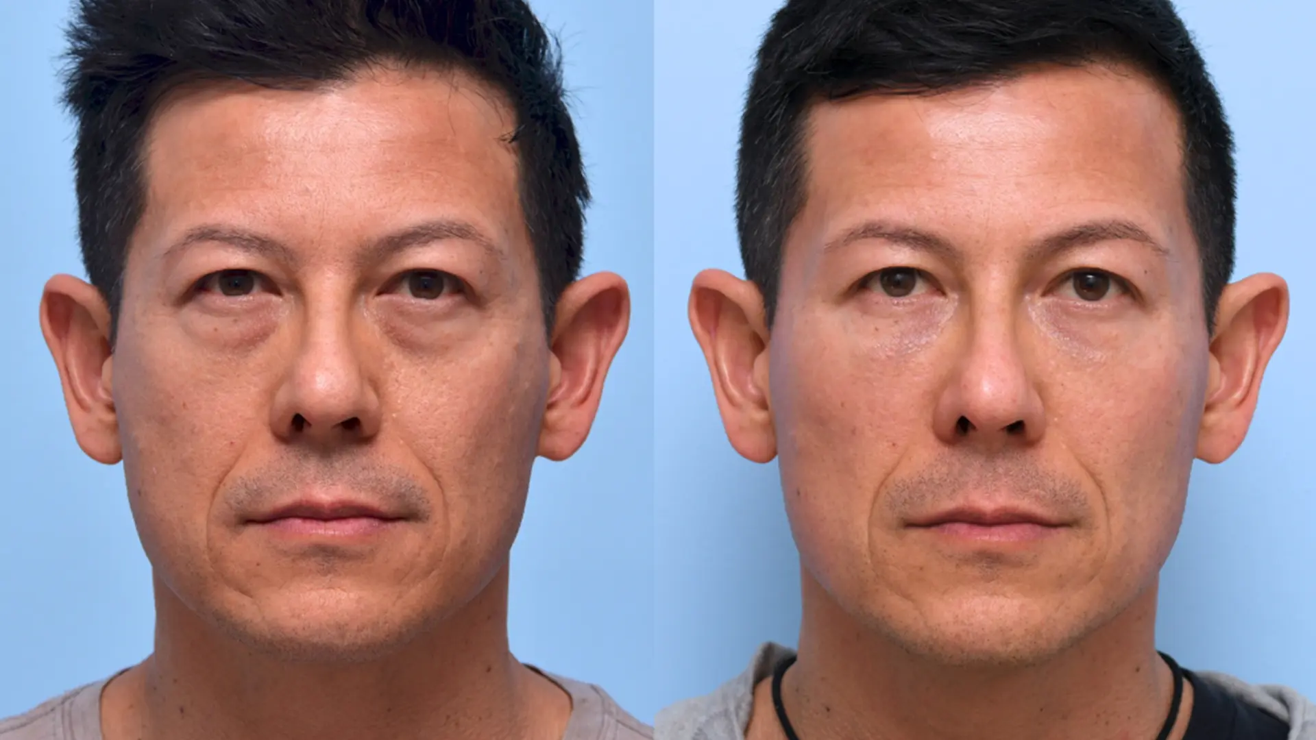 Tear Trough Fillers Before and After 2