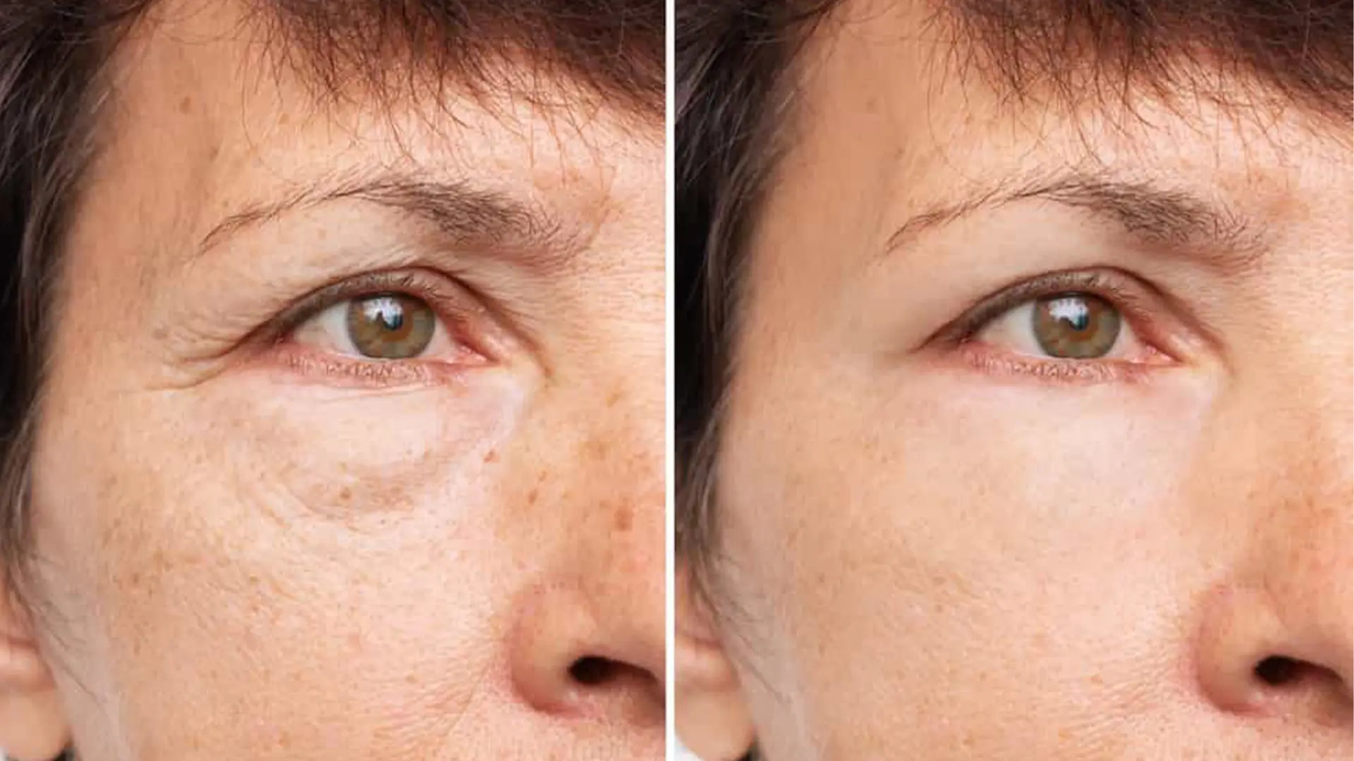 Tear Trough Fillers Before and After 3