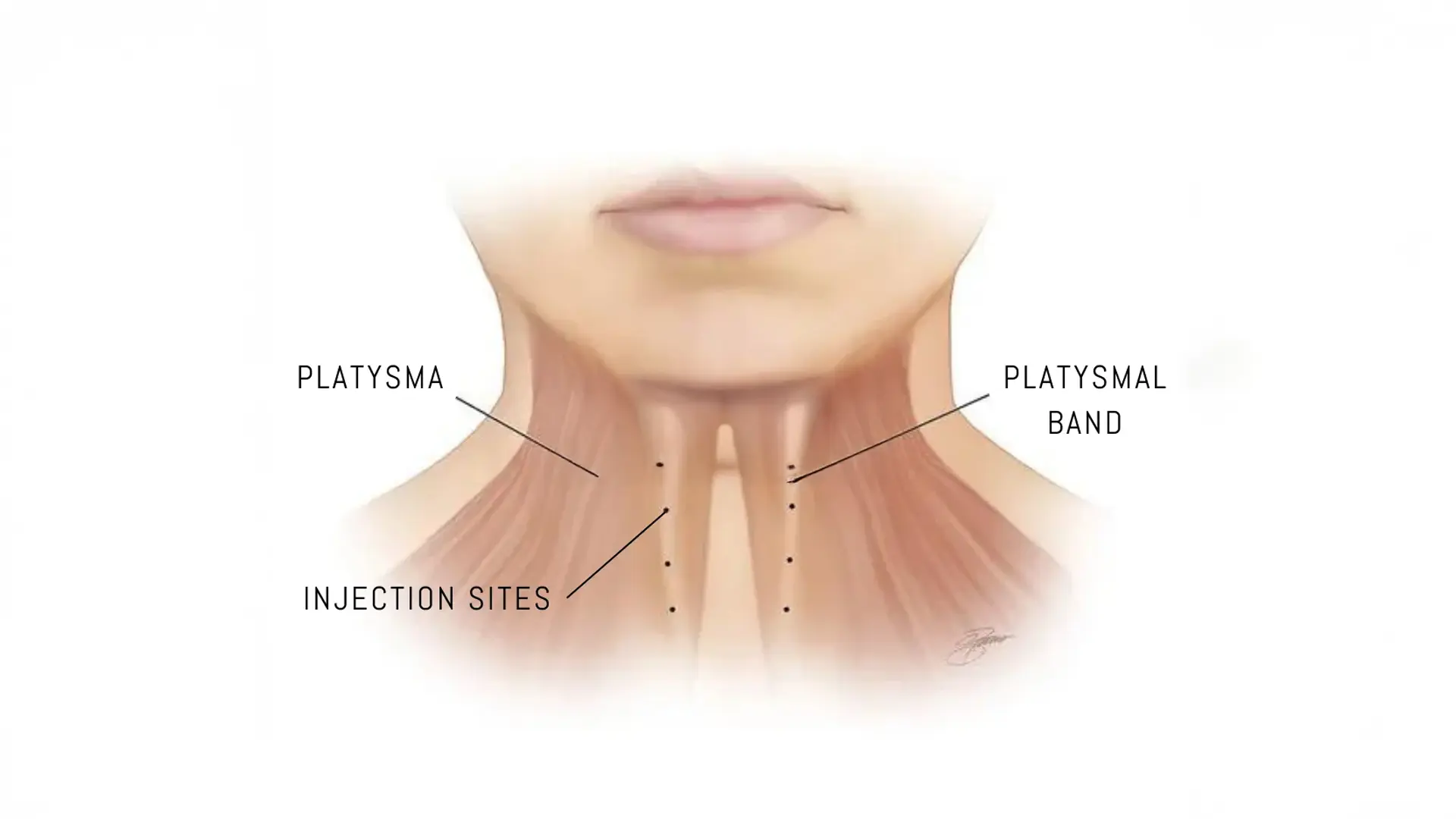 What Are Platysmal Bands