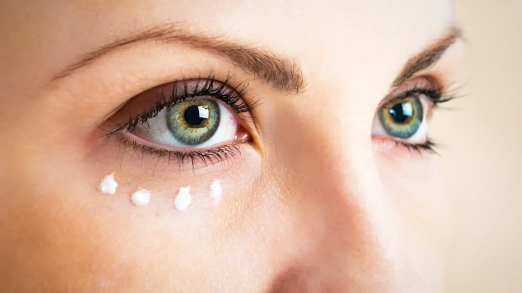 Que esperar después del tratamiento con rellenos dérmicos para ojeras