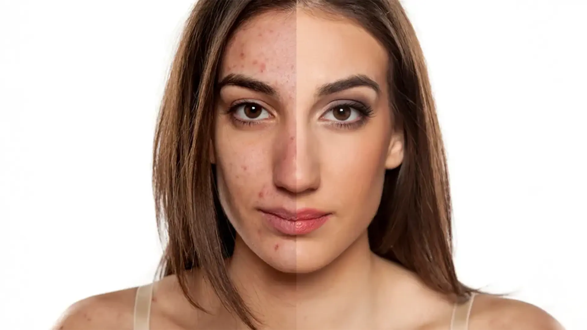 Acne Scar Treatments: Proven Solutions for Clearer Skin