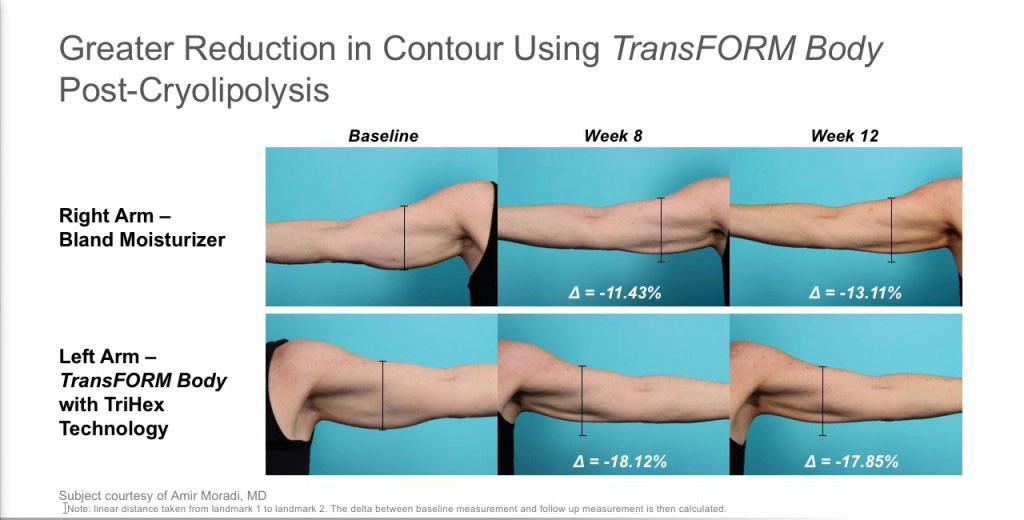 Alastin Transform Body Treatment results