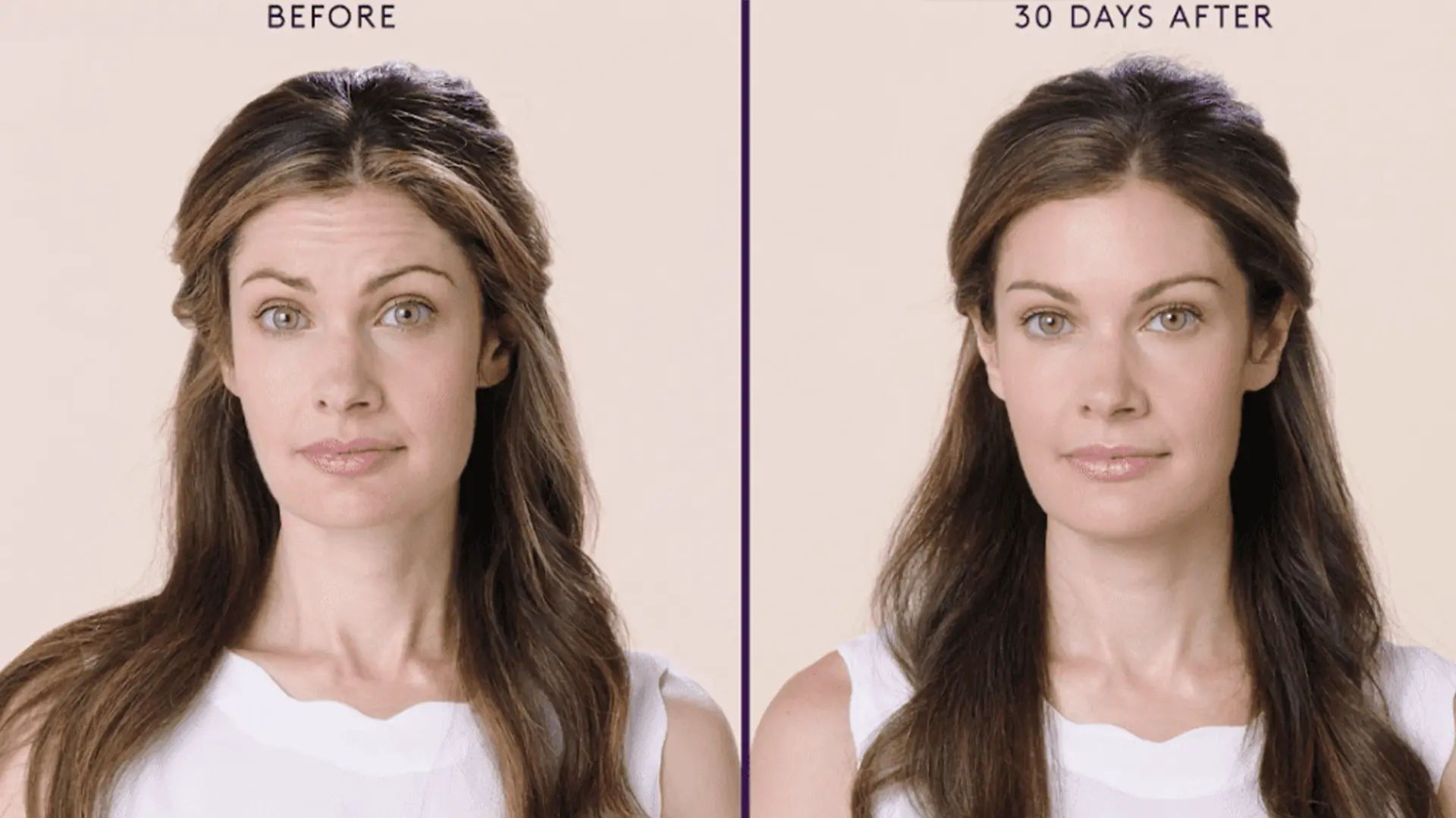 Comparación de antes y después de Baby Botox