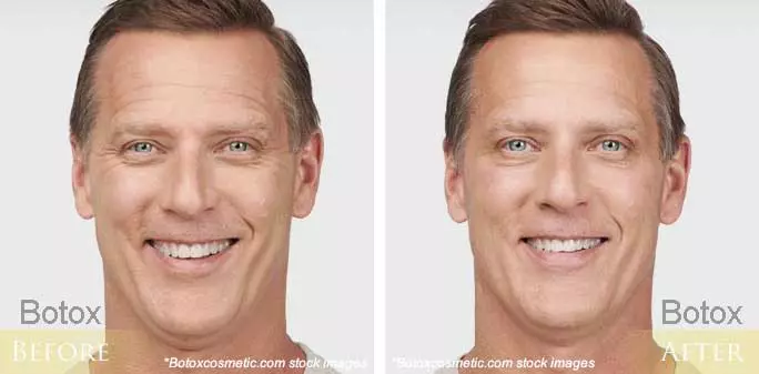 Before and after Botox treatment for men - forehead and frown lines