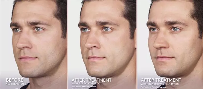 Before and after Botox for men - crow's feet and eye area