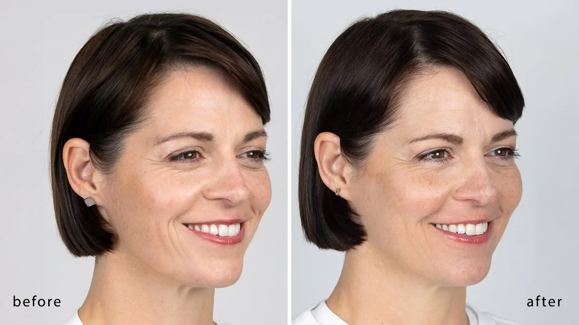 Biostimulator treatment before and after comparison