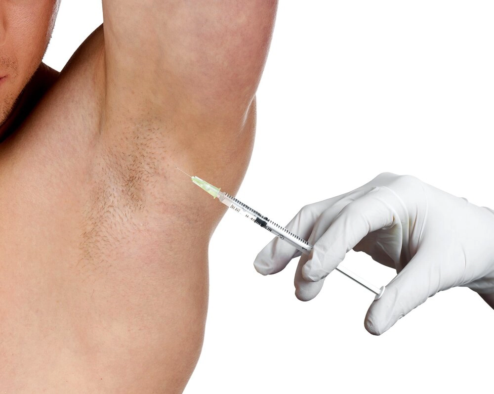 Botox for Armpit Sweat and Hyperhidrosis Treatment