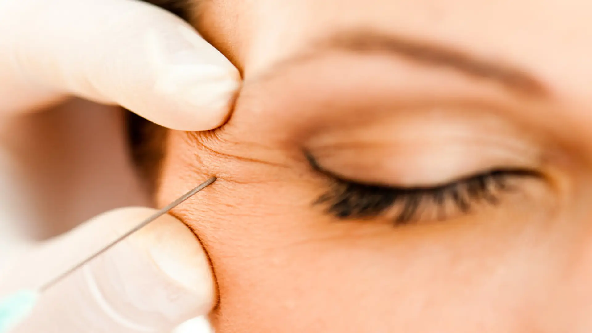 How Botox can help beyond wrinkle reduction — treatment areas and benefits