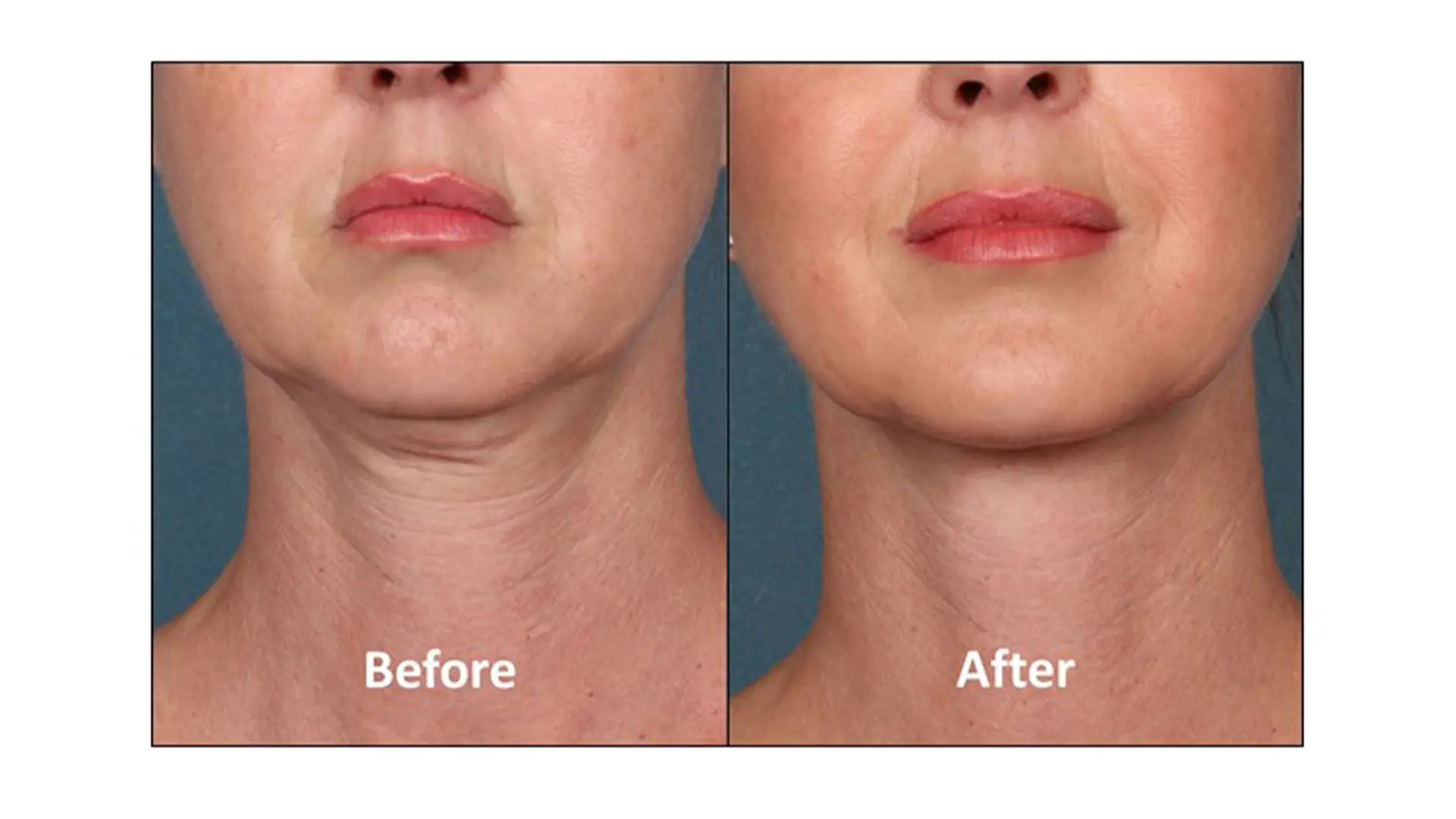 Botox for Double Chin Before and After 1