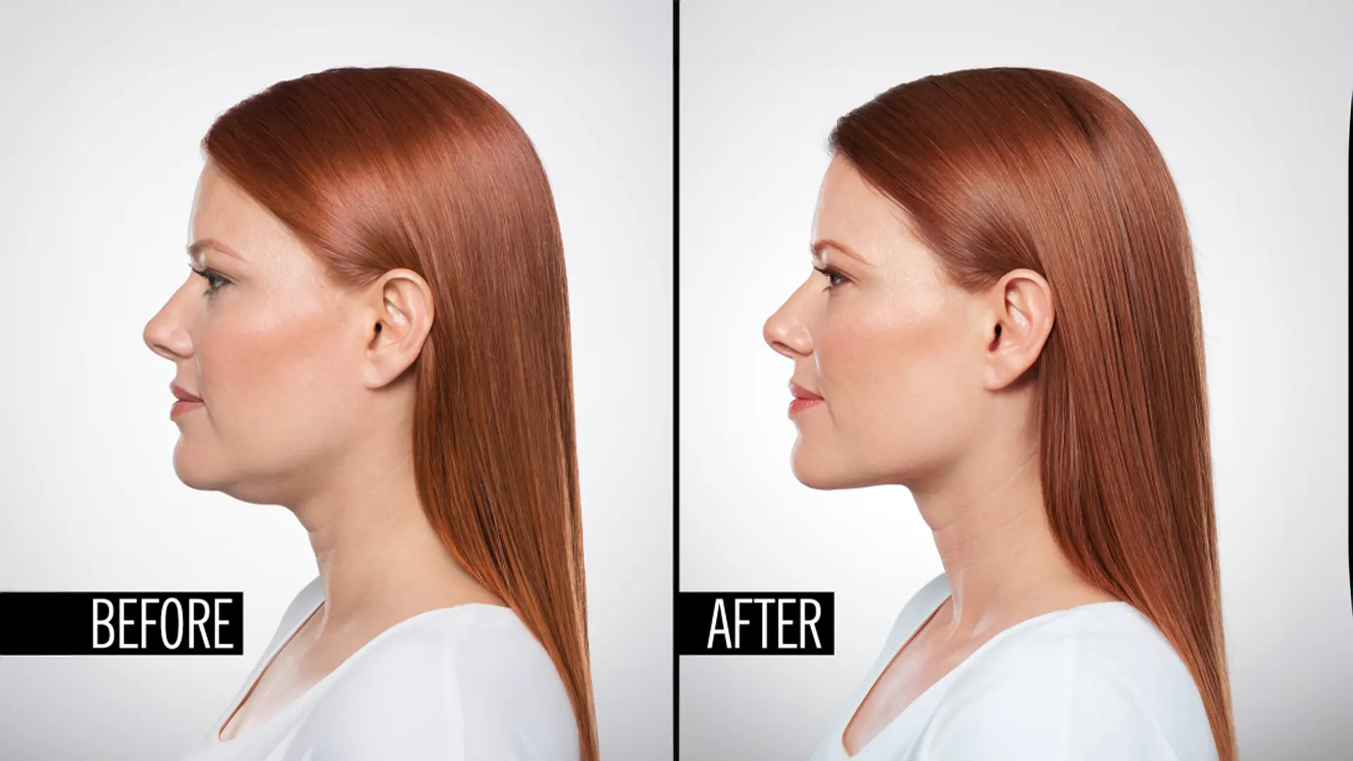 Botox for Double Chin Before and After 2