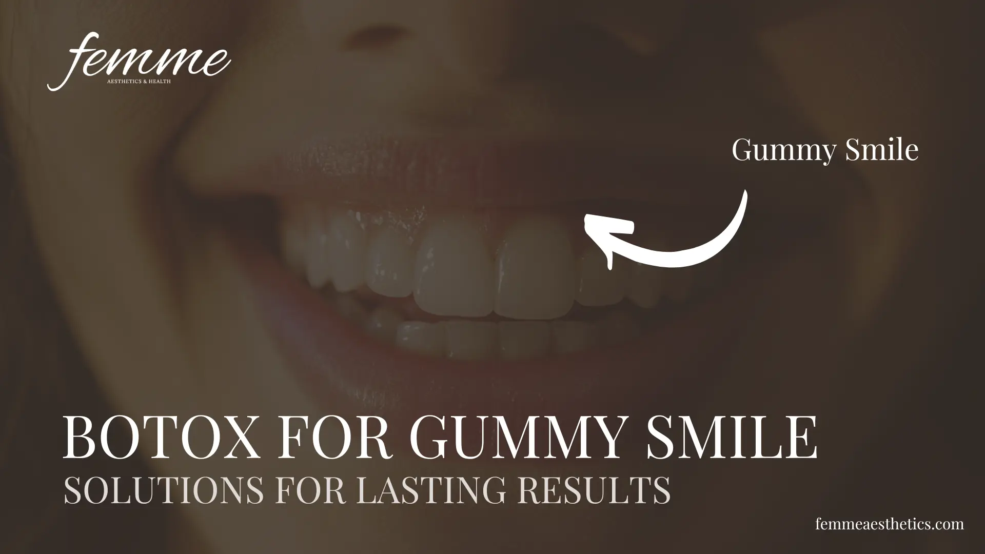 Botox For Gummy Smile Treatment at Femme Aesthetics Miami