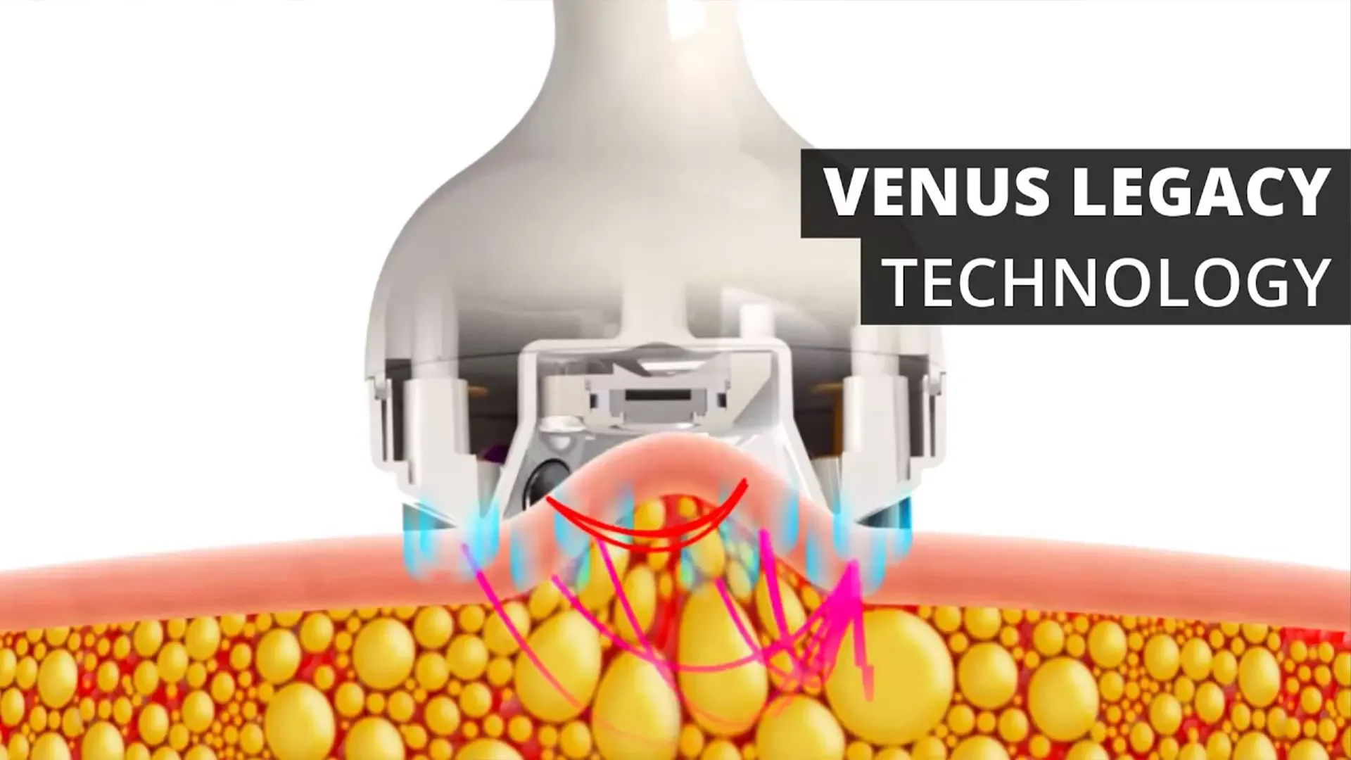 Venus Legacy cellulite treatment