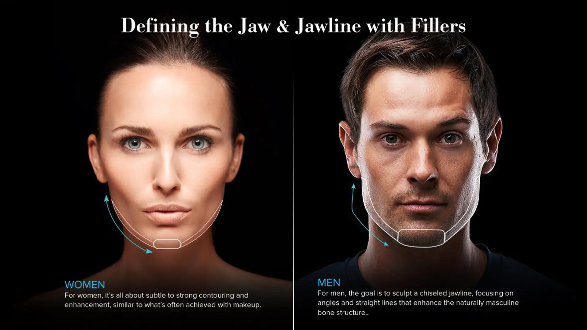 Chin filler treatment