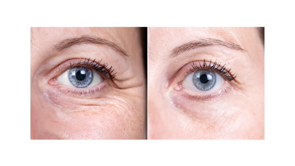 Rellenos dérmicos para ojeras antes y después resultado 1