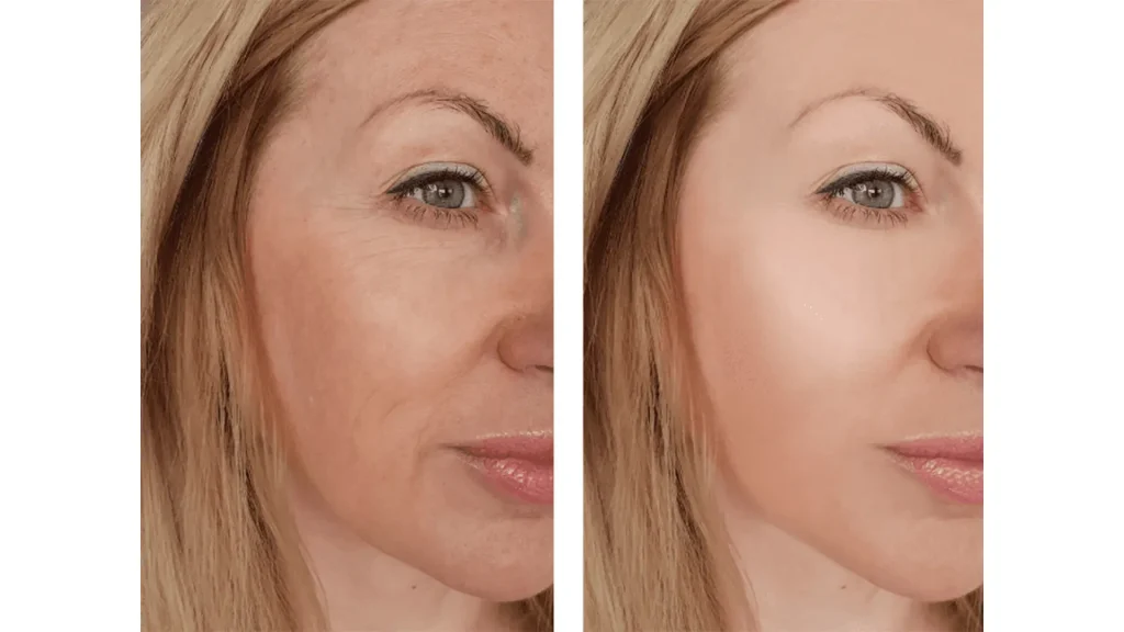 Rellenos dérmicos para ojeras antes y después resultado 2