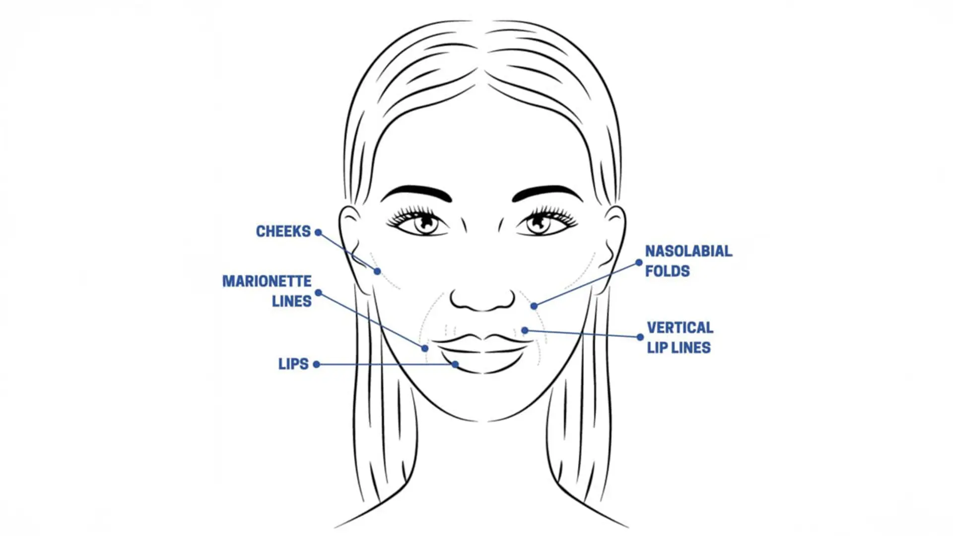 Dermal Fillers What to Expect