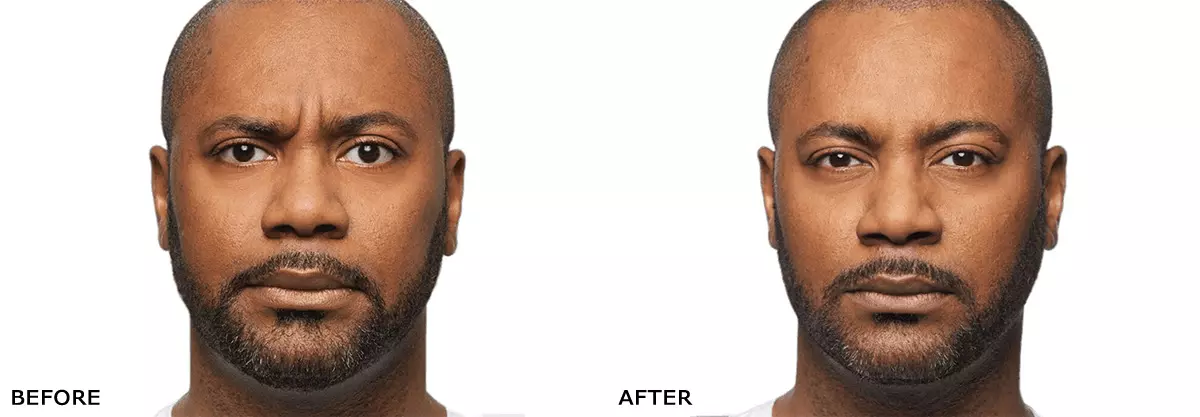 Dysport before and after results - man showing crow's feet and forehead improvement