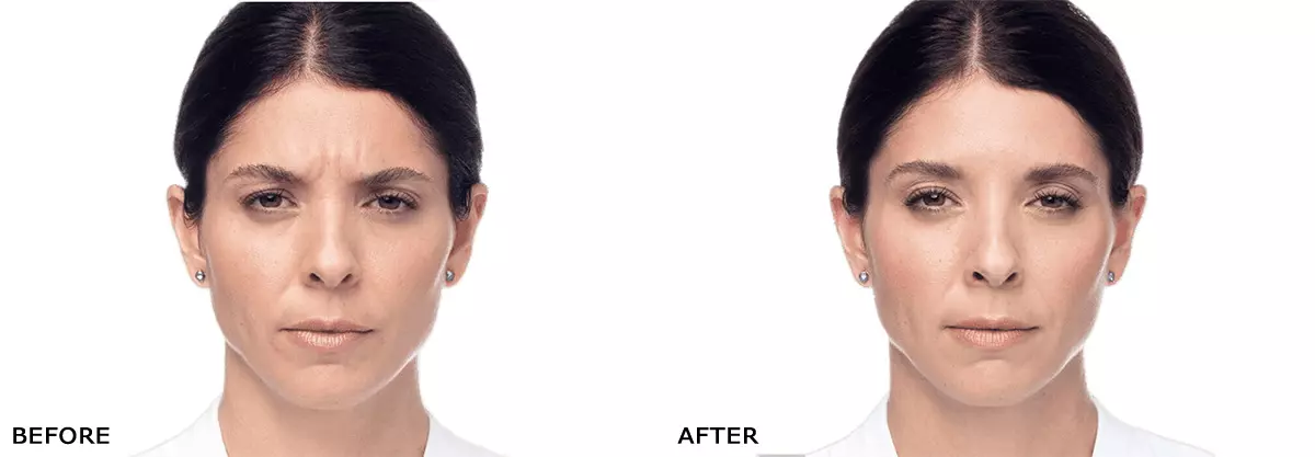 Dysport before and after results - woman showing forehead and frown line improvement
