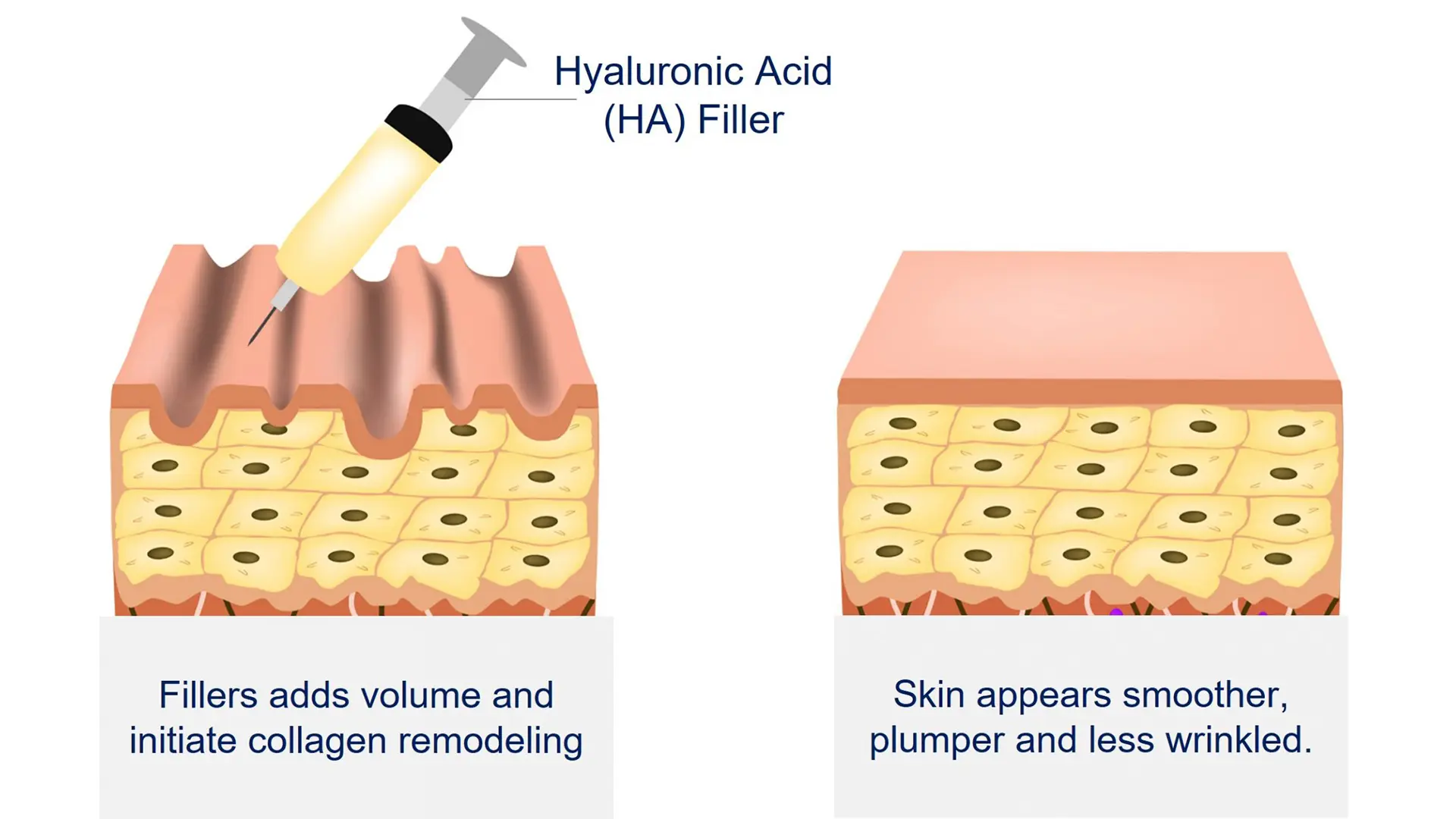 how wrinkle fillers work
