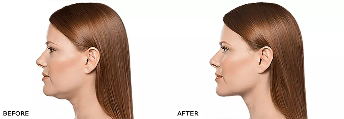 Kybella Before and After Results
