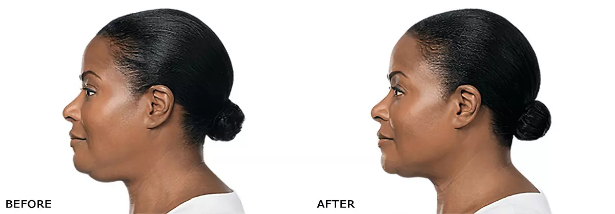 Kybella Results - Side Profile View