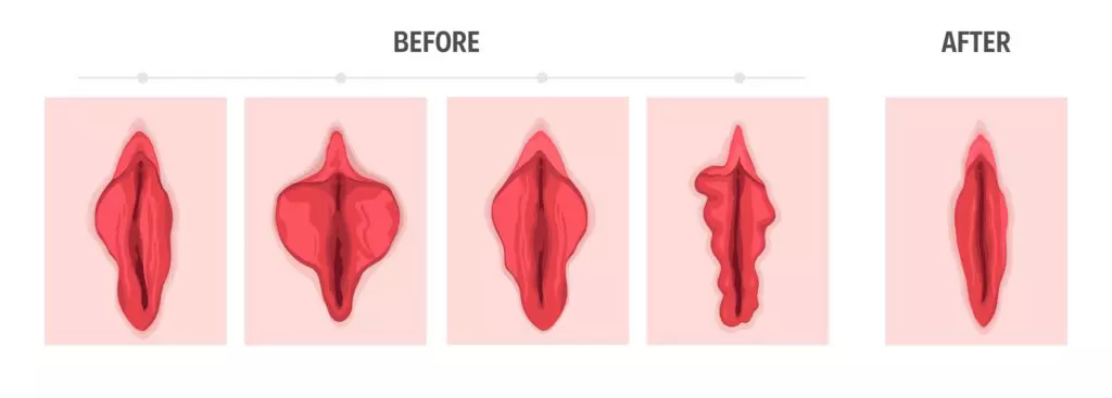 Labiaplasty before and after results