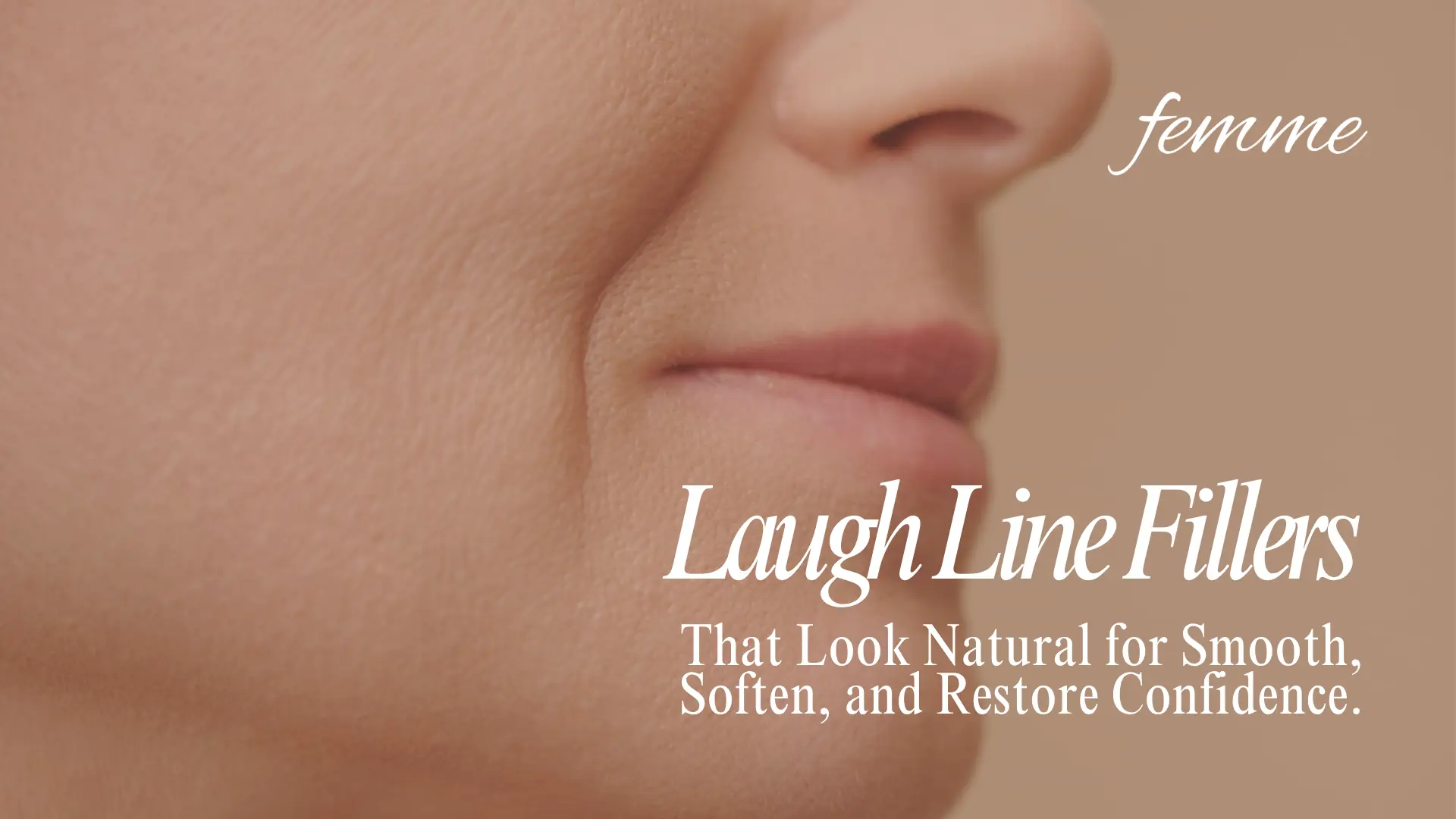 Laugh line fillers
