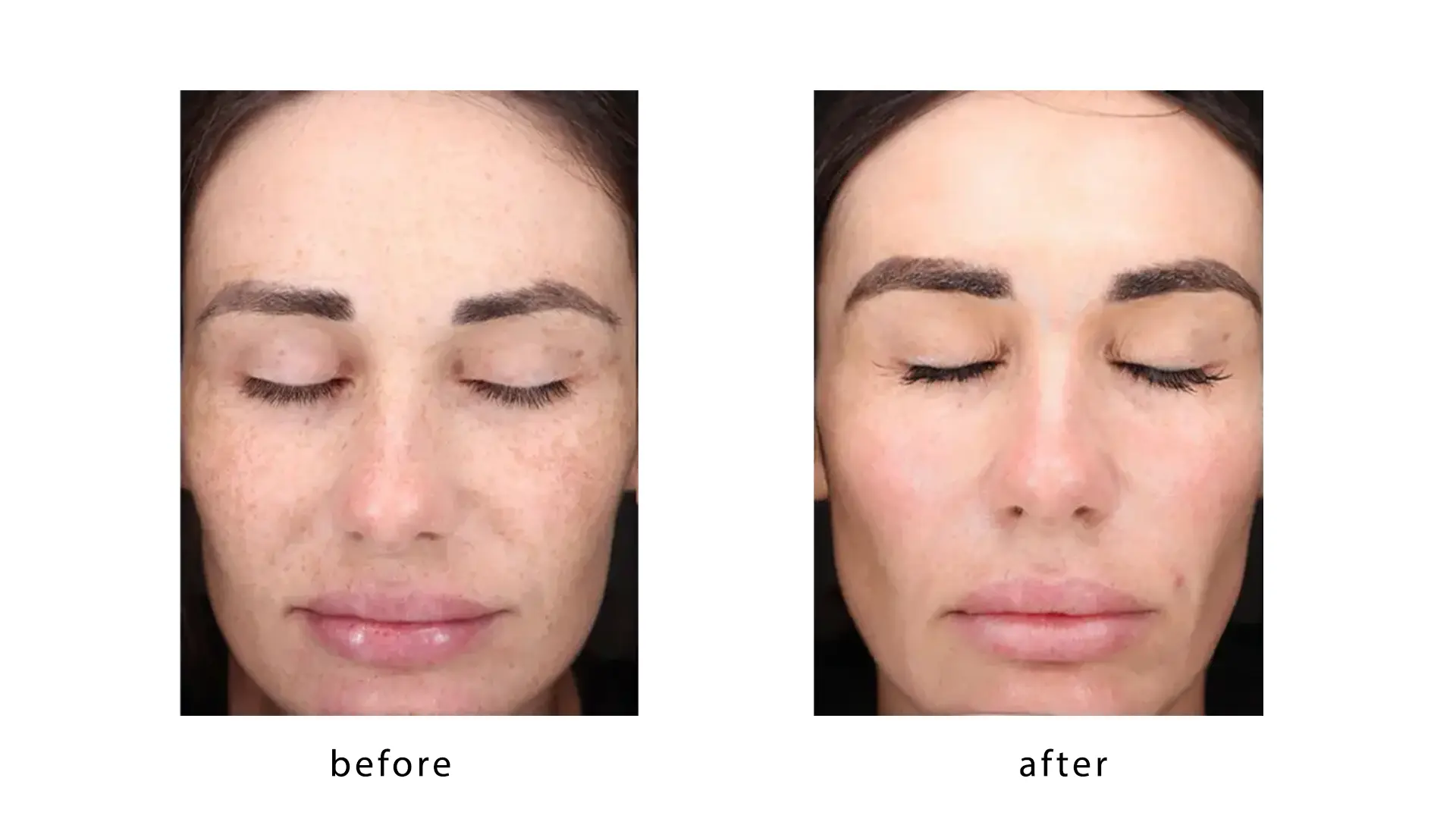 Lumecca IPL before and after results for skin rejuvenation